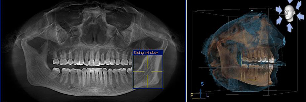 3D Panormaaufnahme des Kieferbereiches eines Patienten
